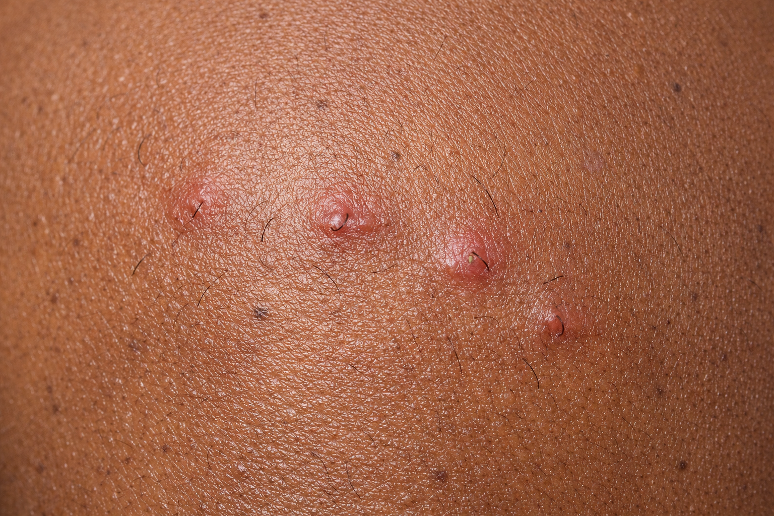 Poils incarnés visibles sur peau mélaninée, inflammation localisée autour des follicules